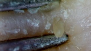 04 Continuous Removal of Blackheads Close up  Squeezing Blackheads [upl. by Jamnes130]