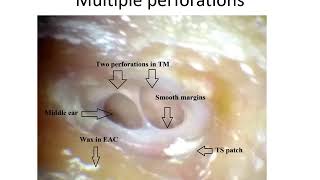 Tubercular Otitis Media  ENT Lecture Series [upl. by Mayfield767]