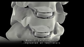 MobiC® Cervical Disc [upl. by Clayberg291]