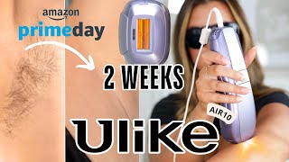 I Tried NEW Ulike Air10 IPL Hair Removal at Home BeforeAfter Results [upl. by Ttehc]