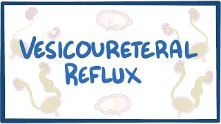 Vesicoureteral reflux  causes symptoms diagnosis treatment pathology [upl. by Nelram584]