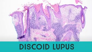 Discoid Lupus Erythematosus under the microscope pathology dermatology dermpath [upl. by Allimaj]