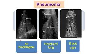 Lecture 3 Lung US Signs in Consolidation [upl. by Neona914]