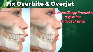 Fix Overbite amp BiMaxillary Protrusion Fix   Subliminal virtual orthodontics treatment [upl. by Kinch]