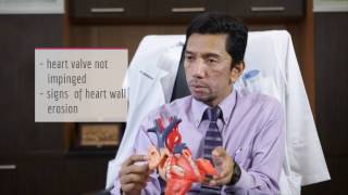 WHAT IS ATRIAL SEPTAL DEFECT ASD [upl. by Atinaj]