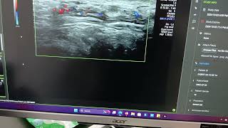 Pampiniform plexus Cyst  Ultrasound  Sonography [upl. by Oilut]