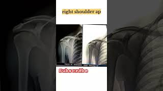 normal right shoulder ap  radiology  viral radiology youtube youtubeshorts anatomy xray [upl. by Eada]