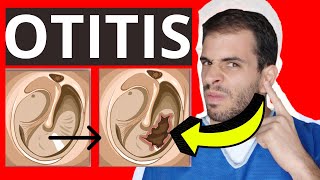 OTITIS 👂 Todo lo que necesitas saber [upl. by Enahpad291]