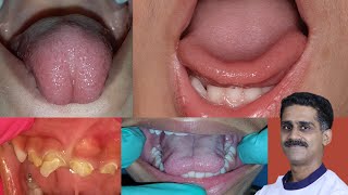 Tongue Tie  often overlooked in our practice [upl. by Claudio]