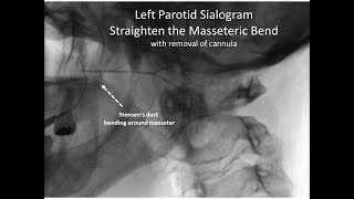 sialogram straighten stensens duct around masseter 11152021 [upl. by Ennayar]