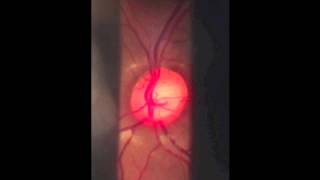 Indirect Ophthalmoscopy final [upl. by Eissac]