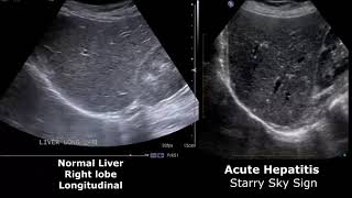 Liver Ultrasound Normal Vs Abnormal Image Appearances Comparison  Liver Ultrasound Pathologies [upl. by Ailedua]