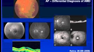 Utilizing Autofluorescence in AMD [upl. by Tyoh823]