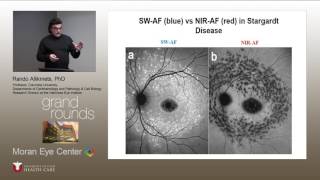 Clinical Spectrum of Stargardt and other ABCA4 Diseases [upl. by Aguayo]