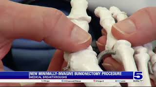 Medical Breakthrough New minimallyinvasive bunionectomy procedure [upl. by Nyladnar115]