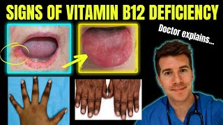 Doctor explains clinical signs of Vitamin B12 cobalamin deficiency  Glossitis mouth ulcers etc [upl. by Schellens]