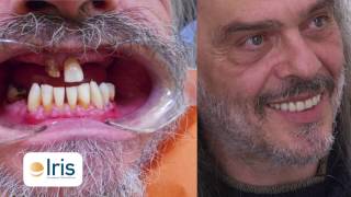 Da zero denti ad un sorriso smagliante [upl. by Pablo]