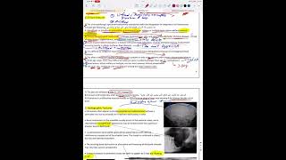 Langerhans cell histiocytosis [upl. by Yecrad]