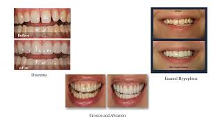 Dept Of Prosthodontics Lec1 Introduction To Fixed Partial Denture [upl. by Fiertz]