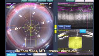 Lensx laser cataract surgery  brunescent cataract 101512 [upl. by Yelbmik360]