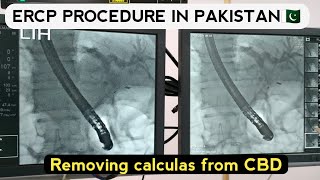 ercp stent procedure video  ercp test video in hindi Ercp in pakistan [upl. by Thorvald335]