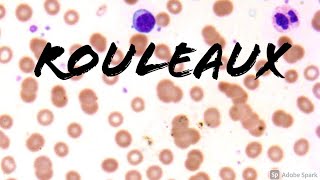 Rouleaux Formation Erythrocytes on Peripheral Blood Smear in Multiple Myeloma Hemepath Hematology [upl. by Betteanne]