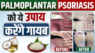 Skin home remedies  Palmoplantar psoriasis treatment  Palmoplantar Psoriasis का घरेलू इलाज [upl. by Almeeta]