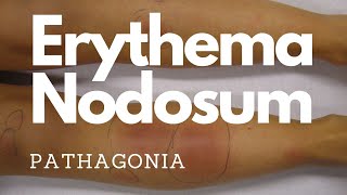 Erythema Nodosum pathagonia [upl. by Entirb]