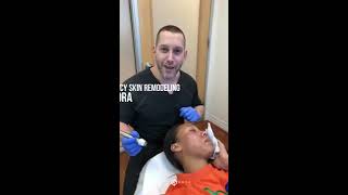 Acne Scar Treatment  RadioFrequency Skin Remodeling  Inmodes Fractora  Dr Jason Emer [upl. by Akemit670]