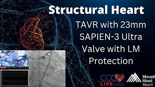 TAVR with 23mm SAPIEN3 Ultra Valve with LM Protection [upl. by Redyr]