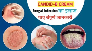 candid b cream  जड़ से करे इलाज  candid b cream for fungal infection  treatment [upl. by Nileuqaj836]