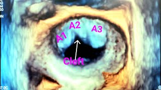 Ostium Primum ASD associated with Mitral Cleft and Moderate MR reviewed using 3D TEE [upl. by Novak671]