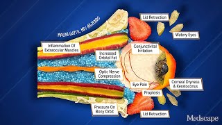 Illustrating the Progression of Thyroid Eye Disease [upl. by Wini616]