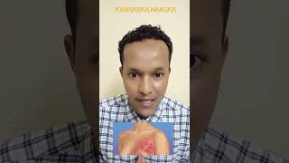 KANSARKA NAASKA BREAST CA [upl. by Allcot]