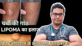 Doctor Explains Lipoma  Treatment without surgery and with surgery । LIPOMA का इलाज बिना ऑपरेशन के [upl. by Eldin]