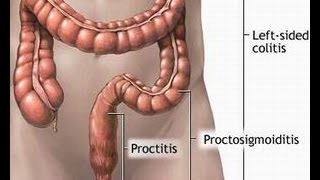 Treatment of Proctitis [upl. by Quickman562]