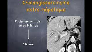 Tumeurs du foie  Malignes  3 Cholangiocarcinome [upl. by Etteb]