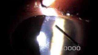 Slit Lamp Techniques  Epithelial Ingrowth Removal 8 days after LASIK Enhancement [upl. by Pollitt]