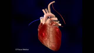 Angioplastiek en bypasschirurgie ter behandeling van atherosclerose [upl. by Paley750]