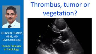 Thrombus tumor or vegetation [upl. by Ahon610]