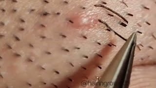 blackheads lipsl Acne treatment l Extraction cysts and blackheads Hair l blackheads lips [upl. by Eaver91]