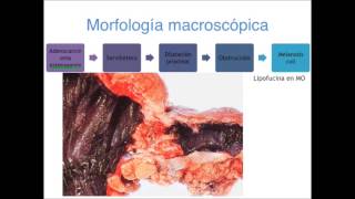 Adenocarcinoma de colon  Patología II [upl. by Baird]