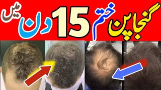 15 Din main Baal Regrowth  Hairfall Solution  How to Use Rogaine Foam Spray [upl. by Soloman]