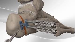 Flatfoot Repair with Arthrex® Calcaneus Step Plate [upl. by Kcyrred808]