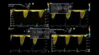 PSEUDO SEVERE AORTIC STENOSIS  STRESS ECHO [upl. by Yonit]