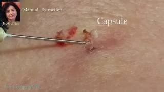 Josefa Removal of a Sebaceous Cyst gigantic blackhead [upl. by Jerrilyn]