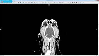 Case Study Treating a Brain Tumor with Stereotactic Radiosurgery SRS  PetCure Oncology [upl. by Danella]