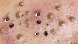 Satisfying big blackhead removal  Pimple popping 120 [upl. by Ressay965]