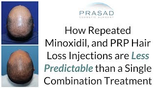 Why Repeat Minoxidil Injections are Less Effective for Hair Loss than a OneTime Treatment [upl. by Adnerb]