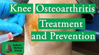 Knee Osteoarthritis Treatment and Prevention  Auburn Medical Group [upl. by Lyndy]